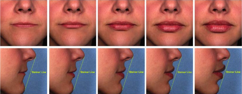 Progressive addition of Juvederm to the lips