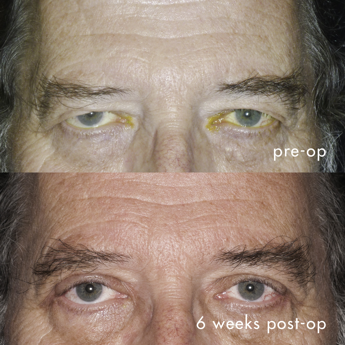Brow lift and upper eyelid blepharoplasty