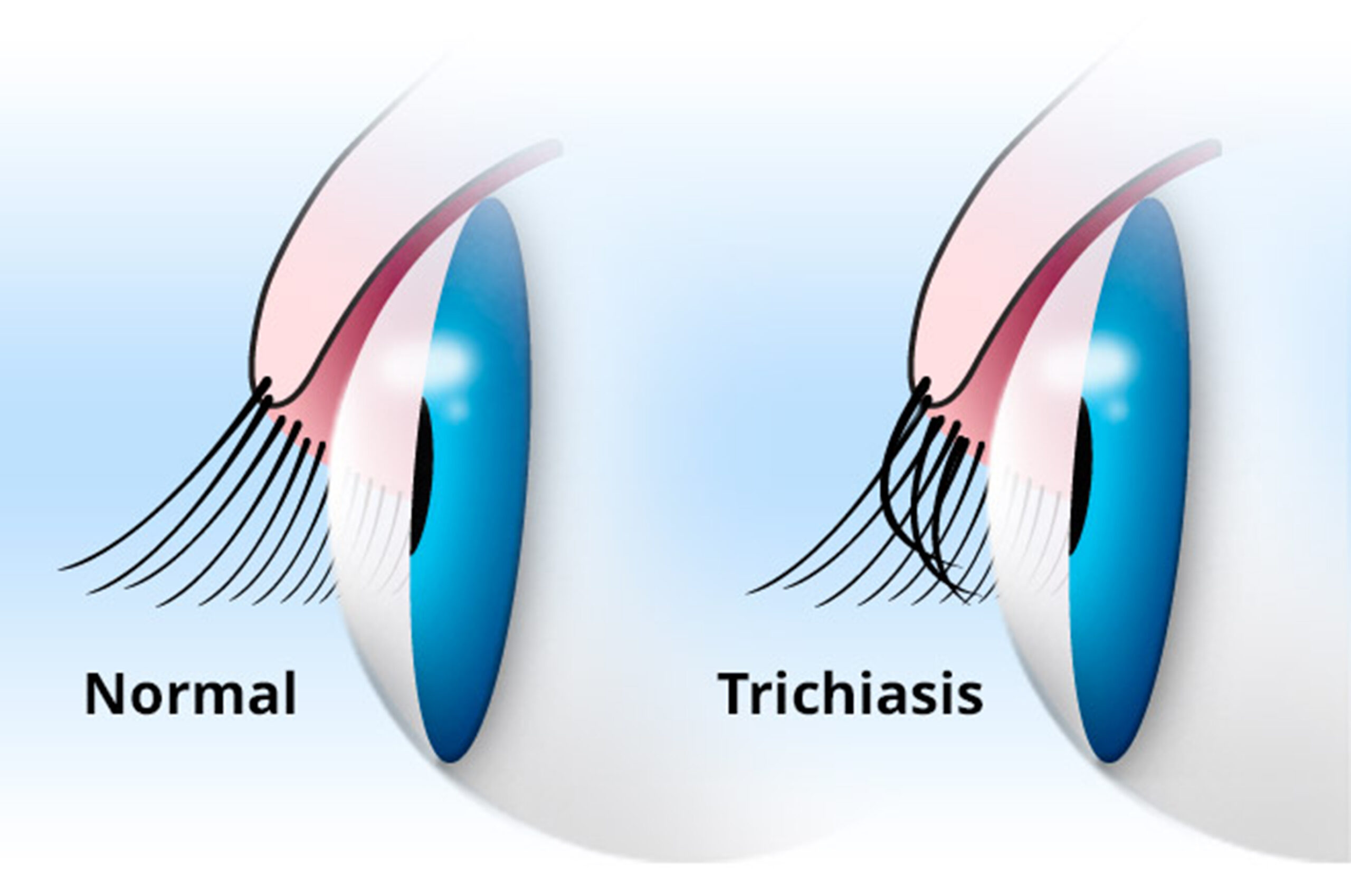 Eyelid trichiasis