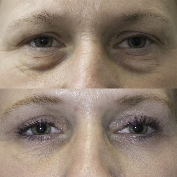 Upper and lower eyelid blepharoplasty