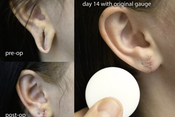 Ear-gauge-repair-BA_3-845x684