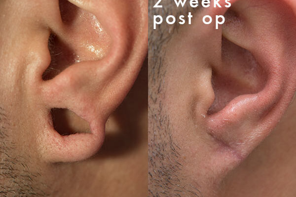 ear-gauge-repair