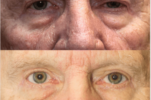 Blepharoplasty before after