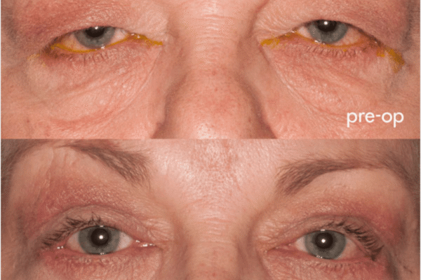 Blepharoplasty before after