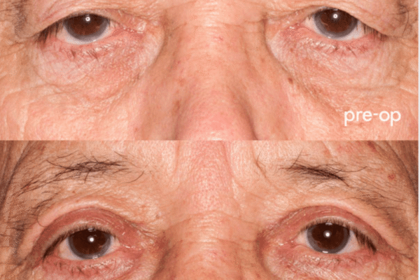 Blepharoplasty before after