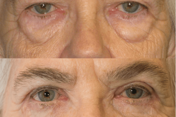 Blepharoplasty before after