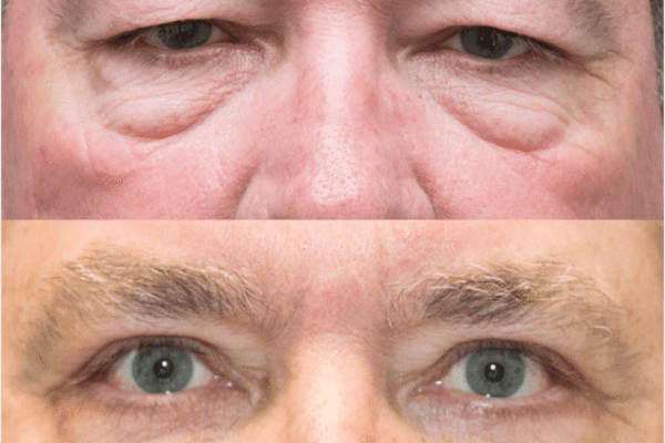 Blepharoplasty before after