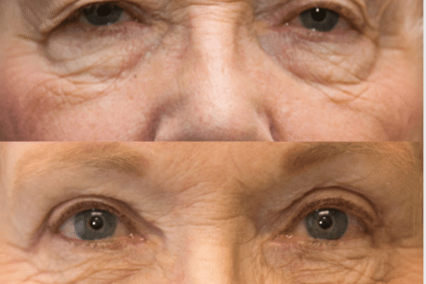 Blepharoplasty before after