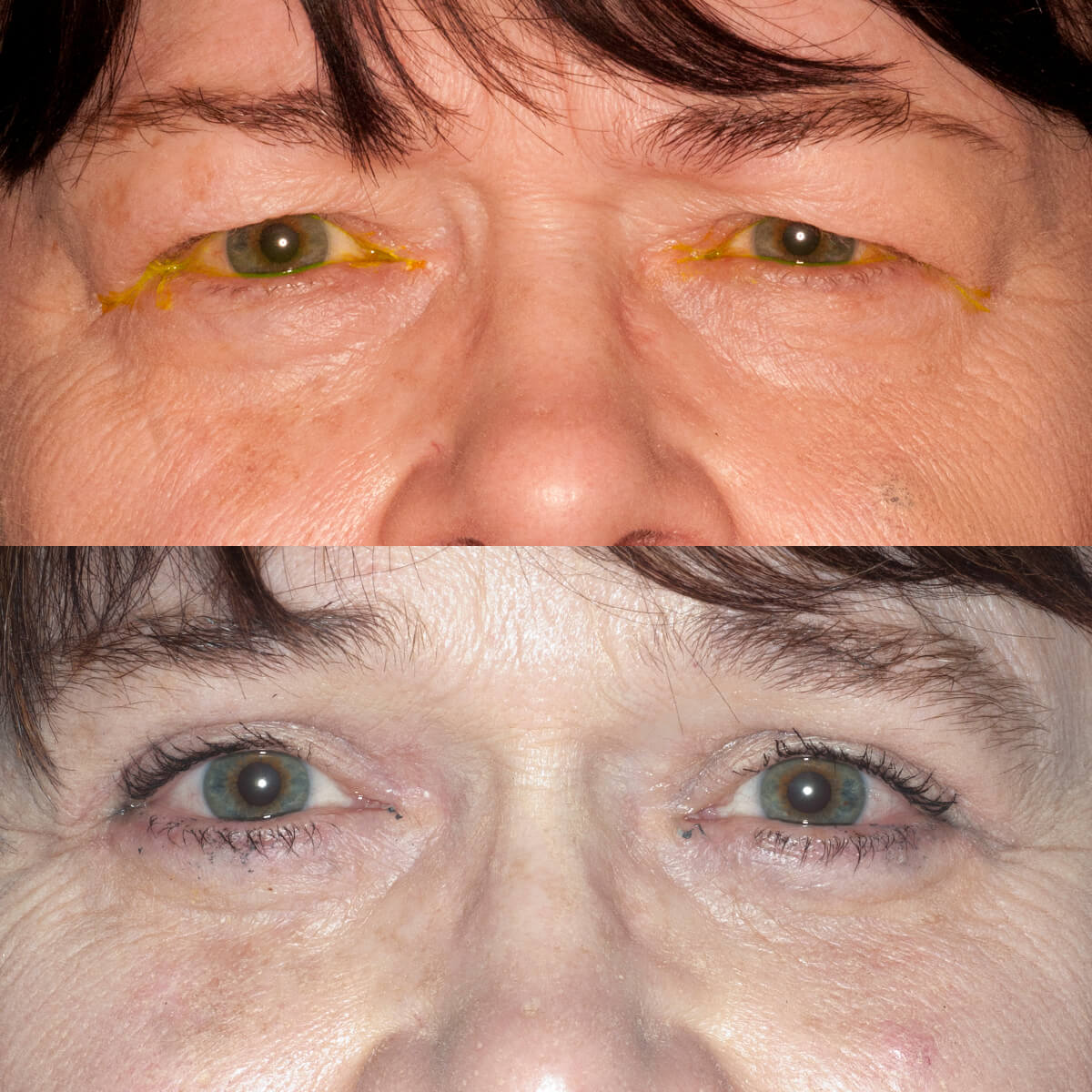 Upper and lower eyelid blepharoplasty