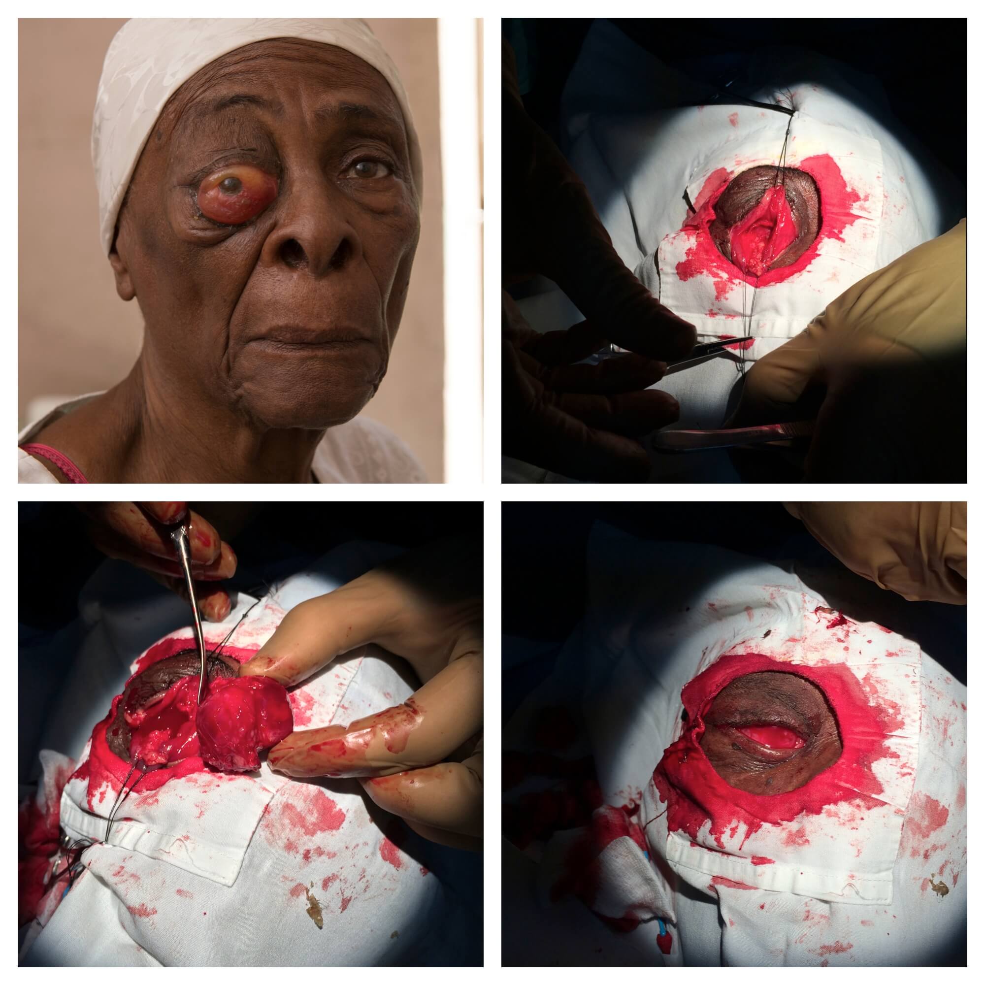 Tumor excision 1