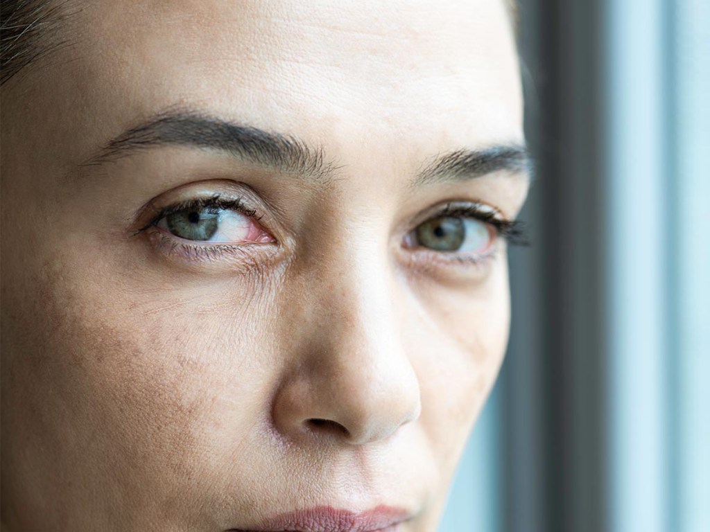 Close-up of a woman's eyes showing mild under-eye bags and fine lines, illustrating common age-related changes that can contribute to a tired appearance.
