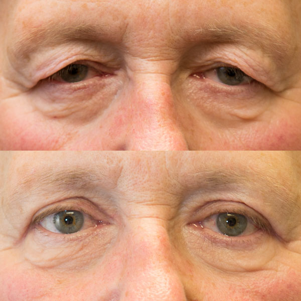 eyelid surgery Upper eyelid blepharoplasty