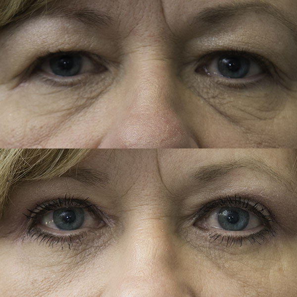 Upper and lower eyelid blepharoplasty