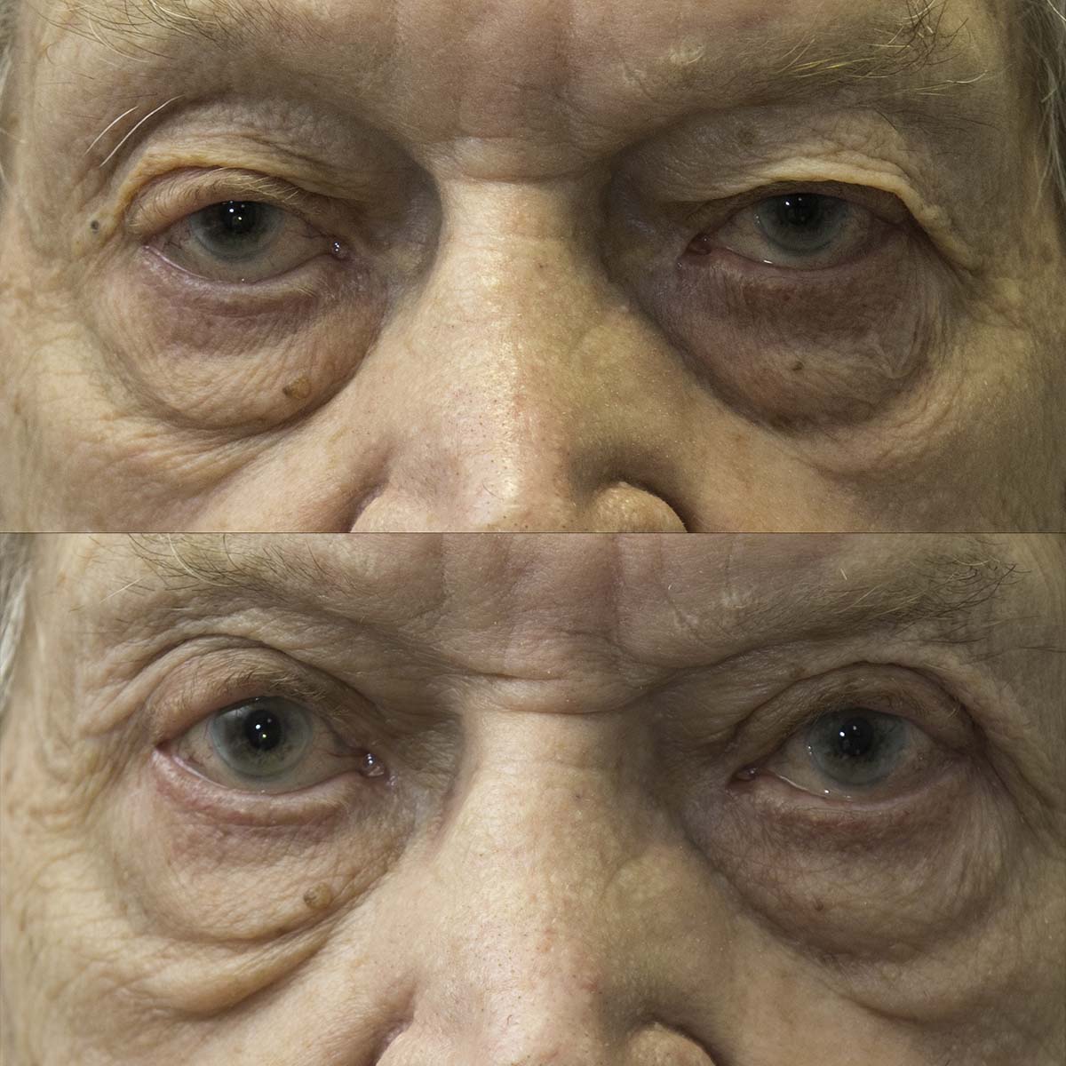 eyelid surgery older man