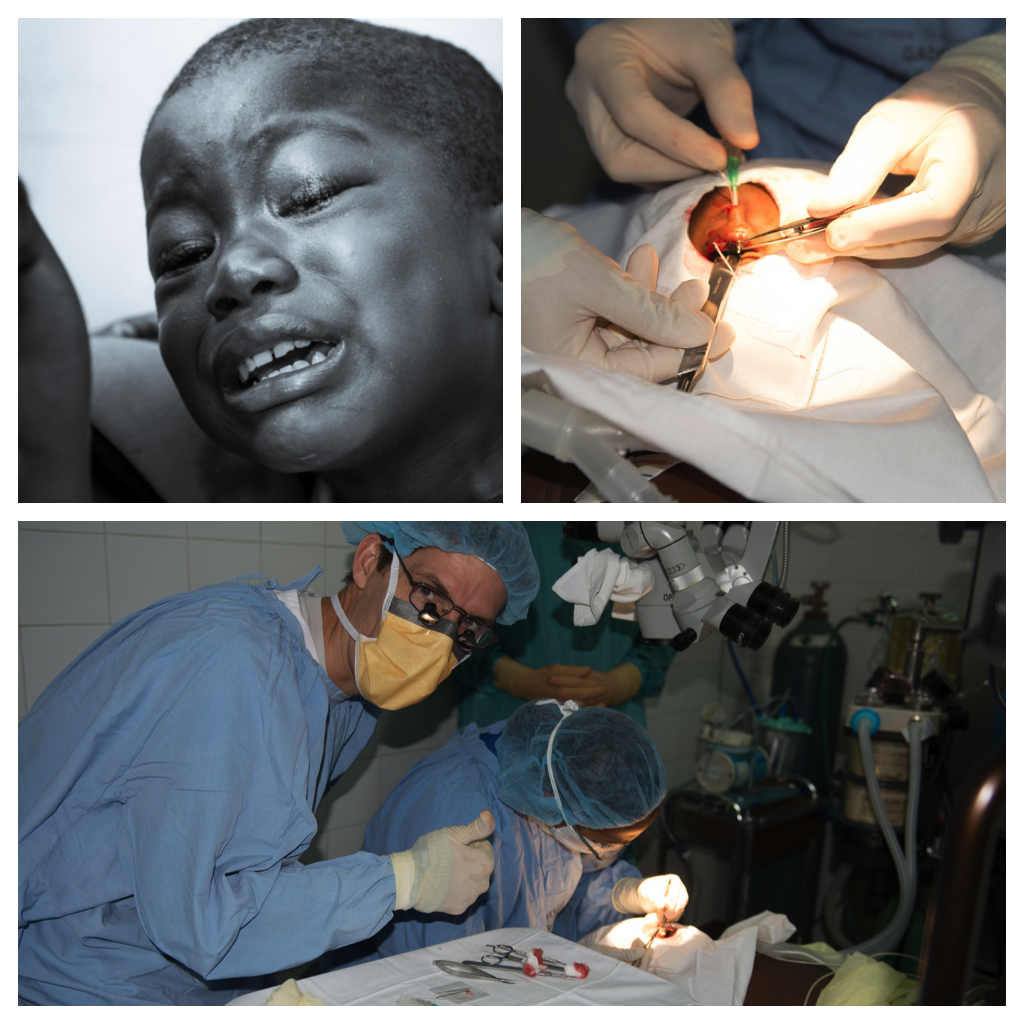 Pediatric ptosis repair in Haiti