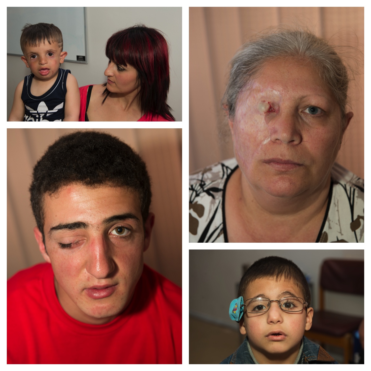 Armenia eye patients