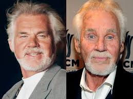 Kenny Rogers before and after plastic surgery
