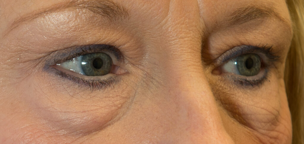 Lower-eyelid-bags