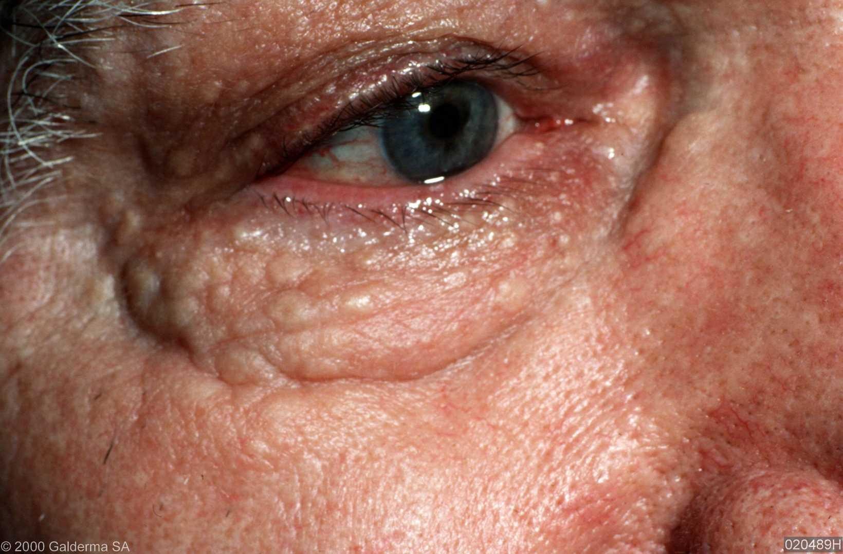 eyelid bumps called syringomas